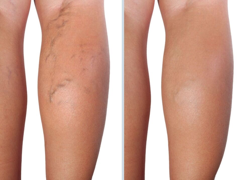 My experience in the application of Neuveris Gel