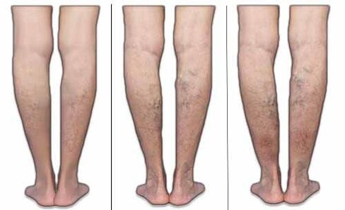 Stages of varicose veins