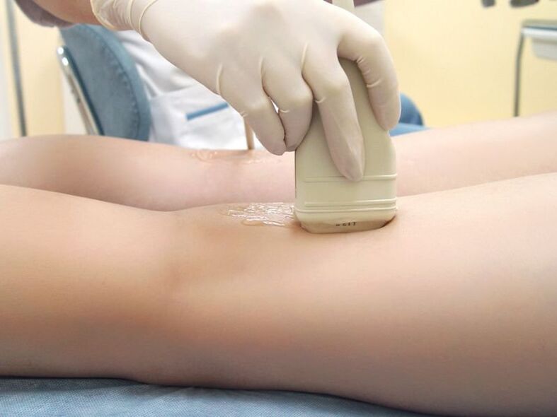 Treatment of varicose veins