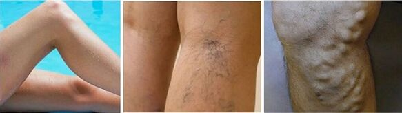 The appearance of varicose veins on the legs