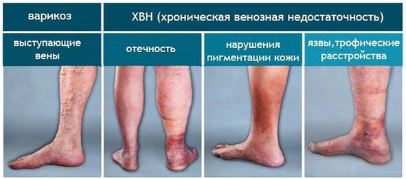 Stages of varicose veins