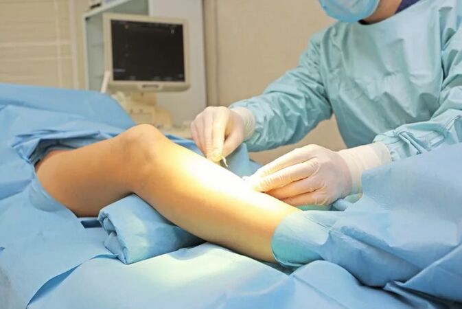 Operation for the elimination of veins on the legs
