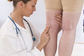 Phlebologist examines patient with varicose veins