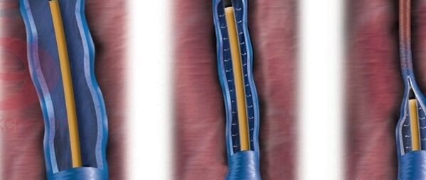 The essence of radiofrequency obliteration in the treatment of varicose veins.