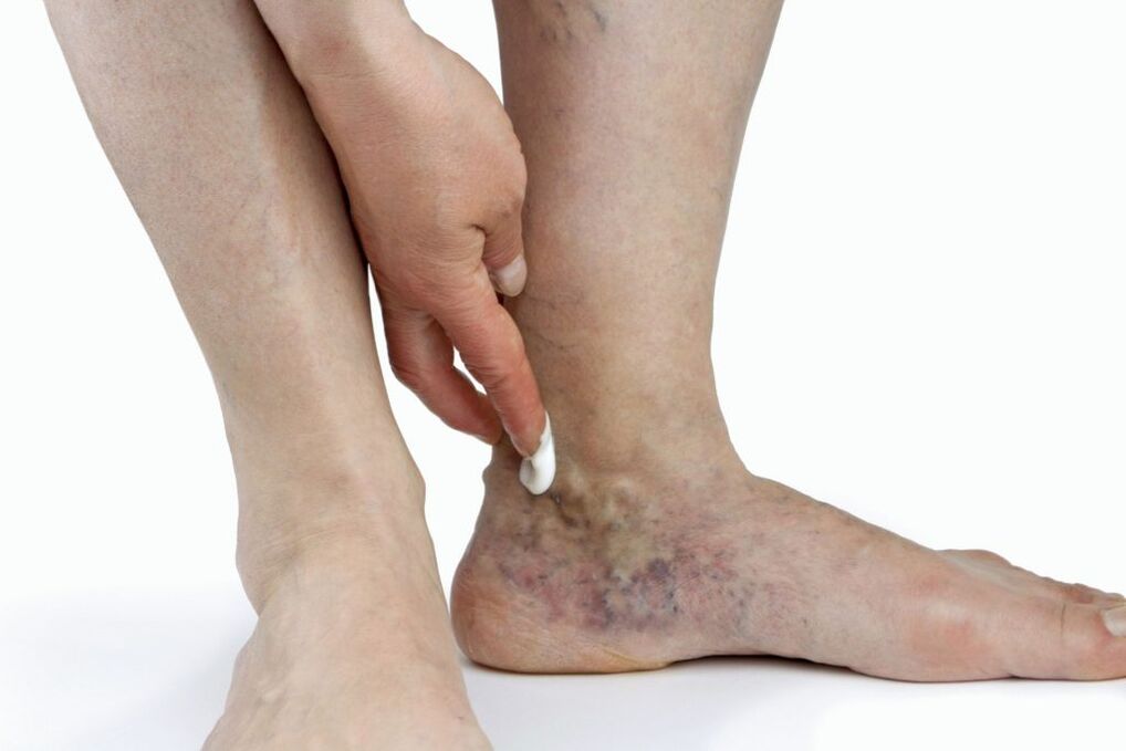 Varicose veins of the lower extremities.