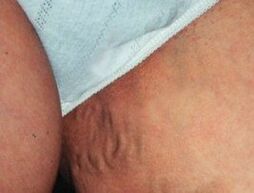 Varicose veins of the pelvis.